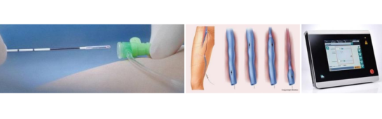 varices, traitement par chirurgie laser