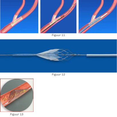 carotides_traitement