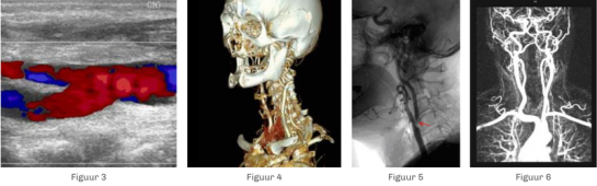 chirurgie-des-carotides