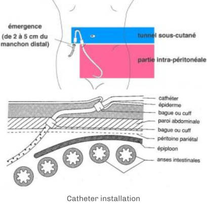 hemodialyse-catheter-installation