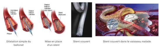 hemodialyse-stent