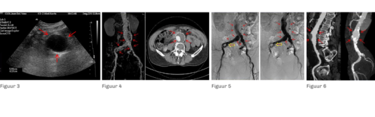 aneurysmatische arteriele ziekten - balans