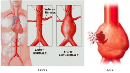 maladies-arterielles-anevrysmales-generalites