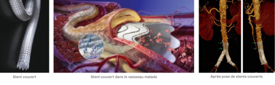 pose-de-stent